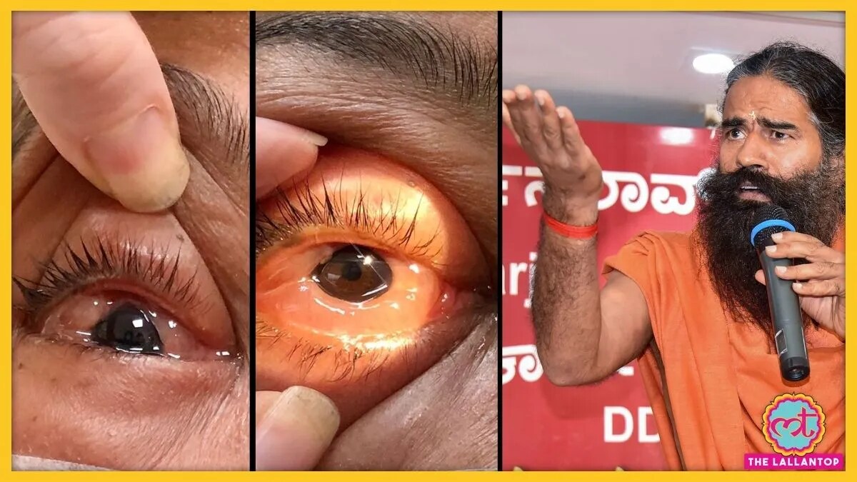 baba ramdev's patanjali eye drop drishti caused severe damage to eyes